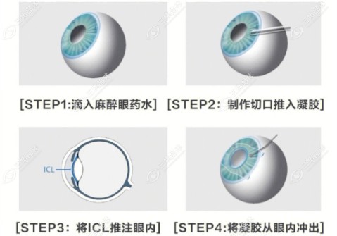 ICL晶体手术