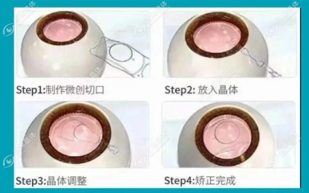 ICL晶体植入
