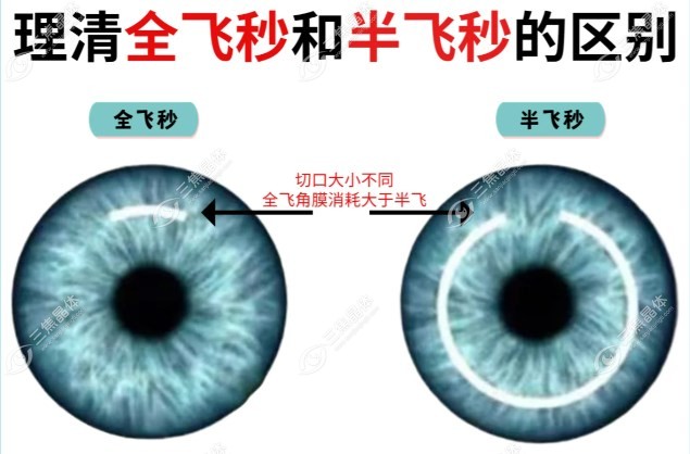半飞秒和全飞秒手术