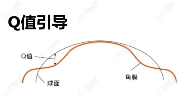 全飞秒手术