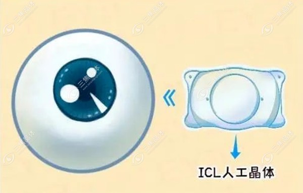 熊瑛和李婧ICL手术就诊流程