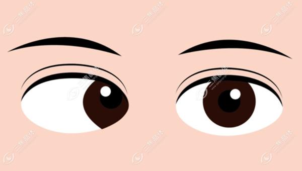 长春吉大二院眼科杨隆艳斜视手术技术好！30年经验医生真实案例解析