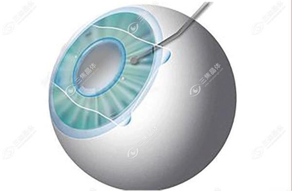 2025南昌全飞秒医院排名榜单揭晓：普瑞/爱尔/华厦眼科领衔，附手术价格对比