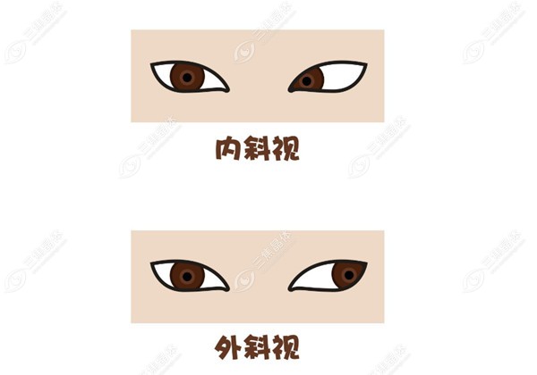 吉大二院眼科杨隆艳与其他斜视手术医生对比