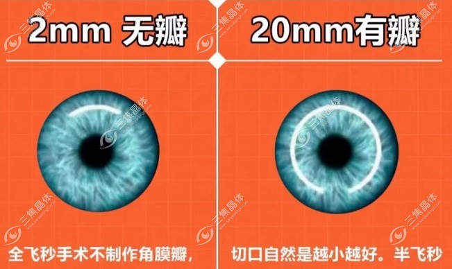 激光手术