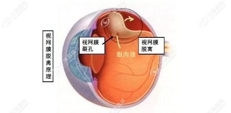 成都近视手术选择医生指南建议 