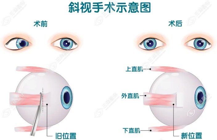 斜视手术