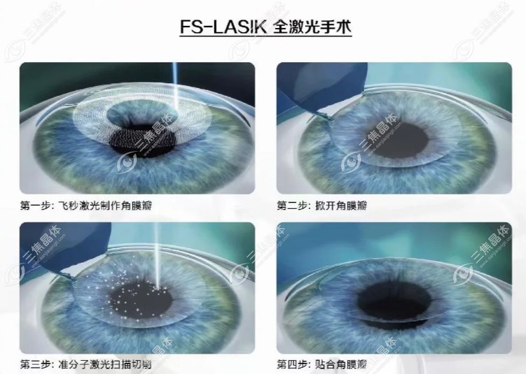 淄博做近视手术，这3点必须提前问清楚，不然容易被“套路”