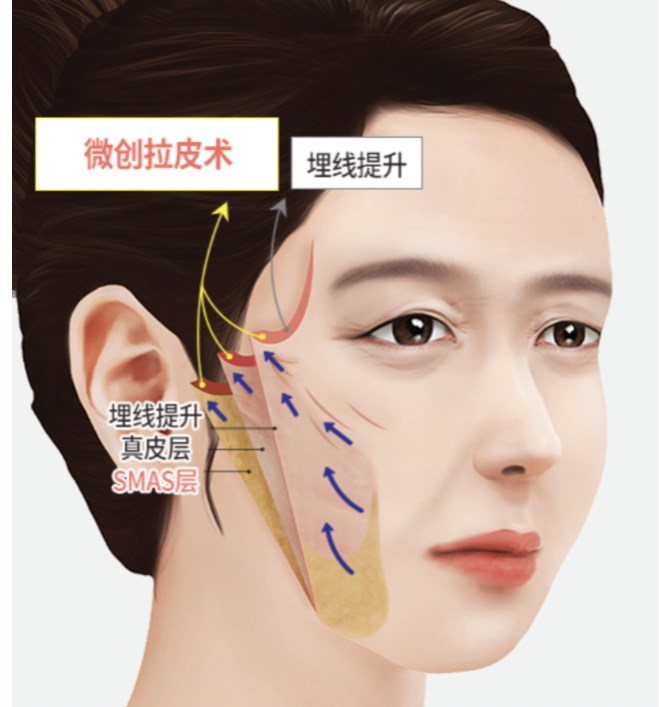 二、聂云飞拉皮手术的三大核心优势