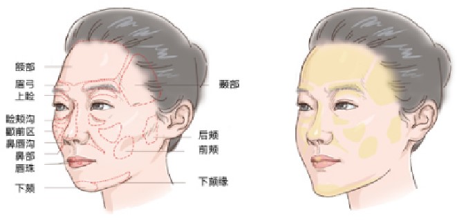 2026广州脂肪填充医生排名前十纯干货分享！揭秘哪家医生技术最牛+真实案例测评避坑指南！