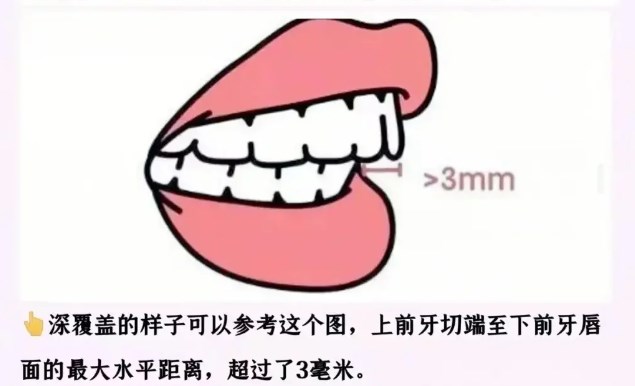 二、关于大家最关心的隐形矫正靠谱吗？