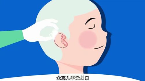 二、安波博士耳再造技术的详细解析