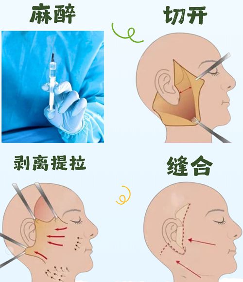 刘暾整形医生拉皮手术案例真实分享：不吹不黑效果惊艳揭秘2026年整形新趋势！